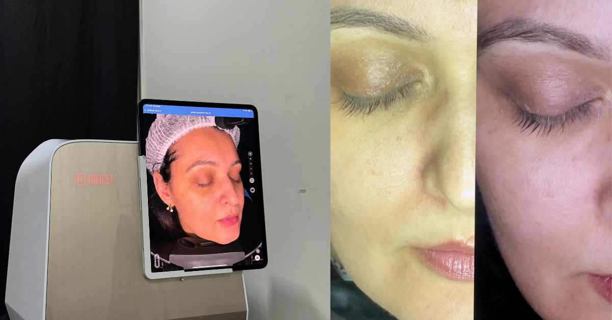 Before and After digital peel EHA clinic