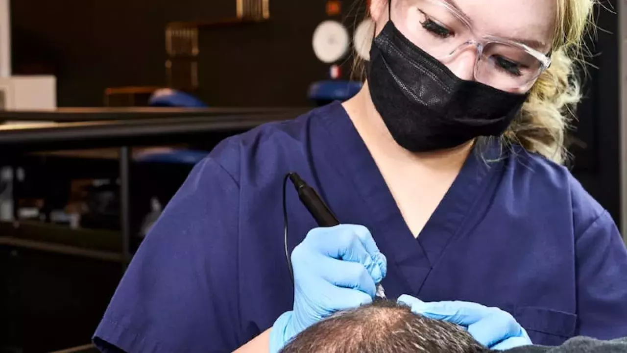 Scalp Micropigmentation vs. Hair Transplant