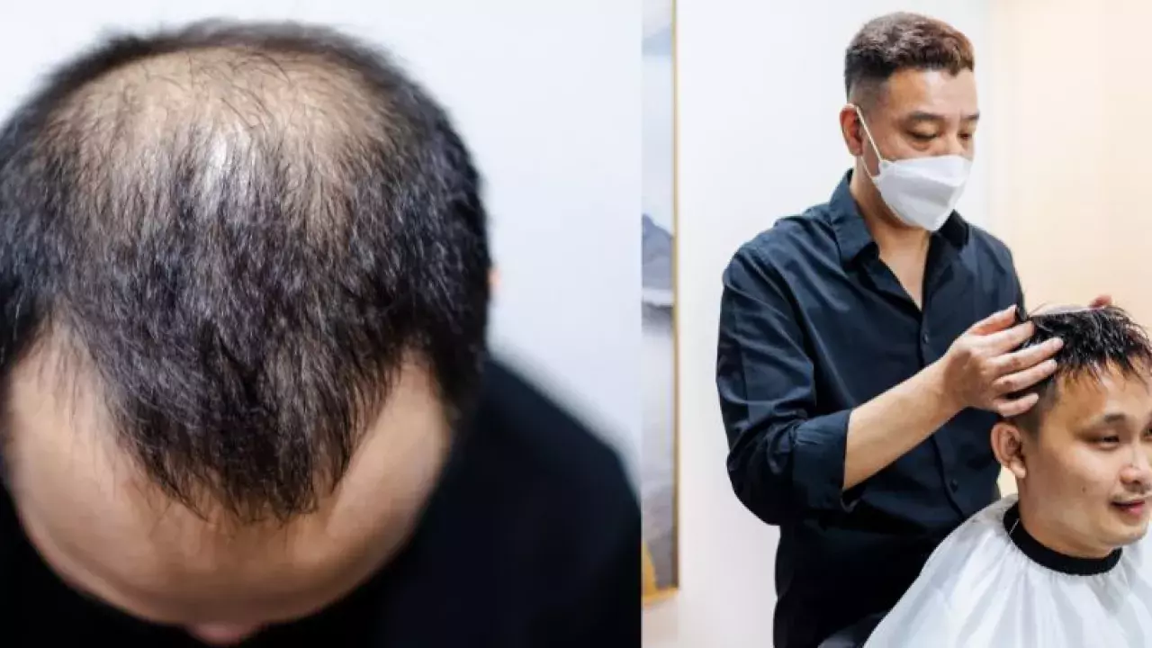 hair loss treatment singapore